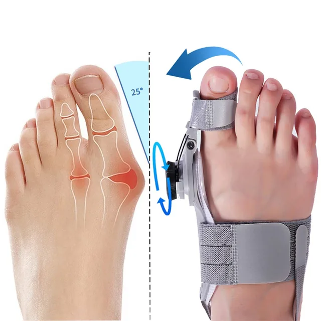 Treatmedy Bunion Fix and bunion alignment results