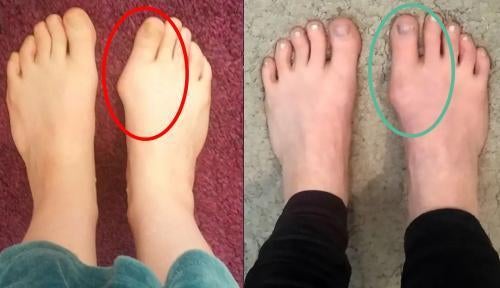 Bunion Fix results shared by Emma S.