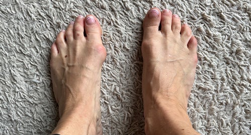 Bunion Fix results shared by Jenny T.