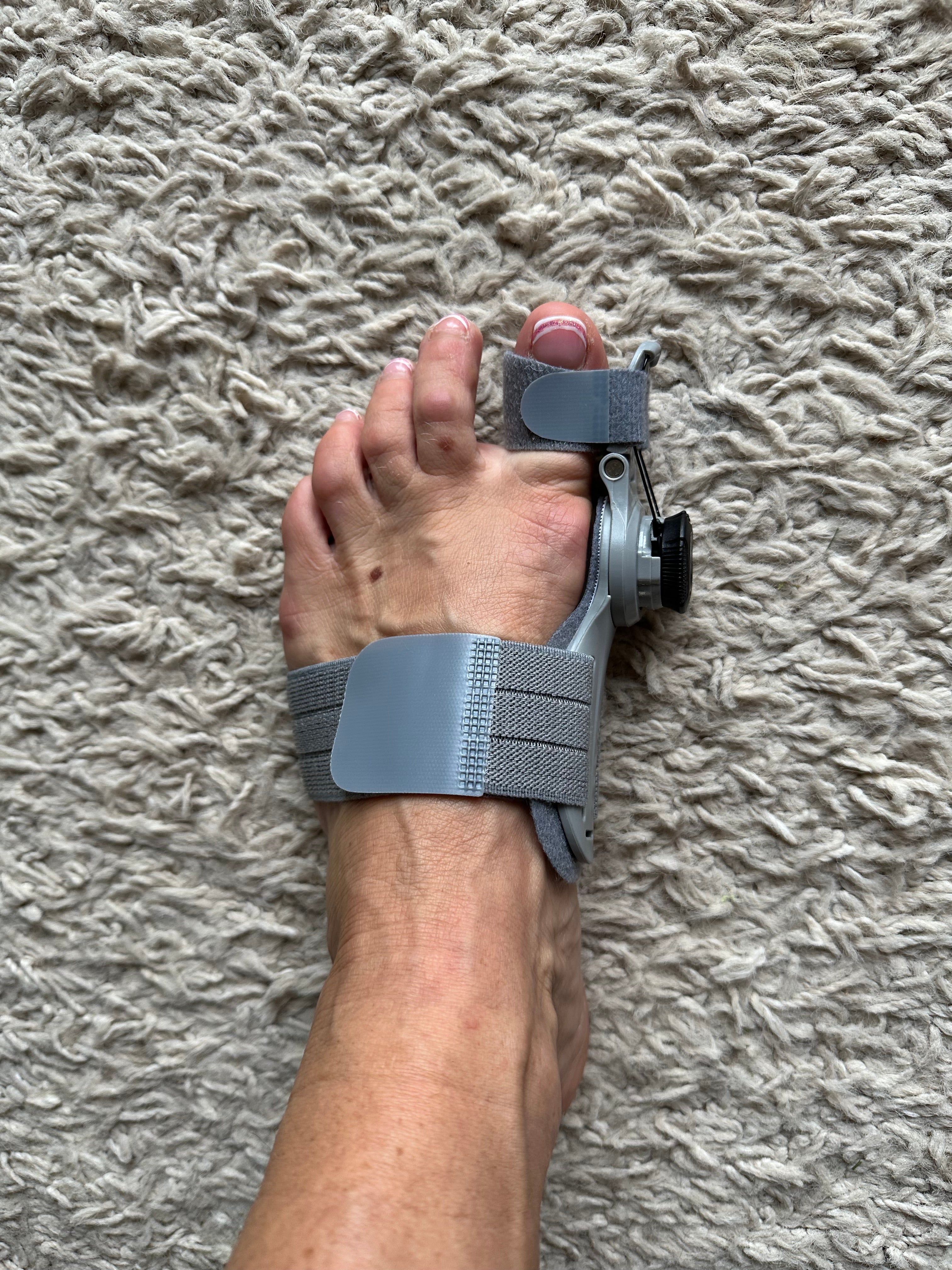 Customer photo of the Bunion Fix