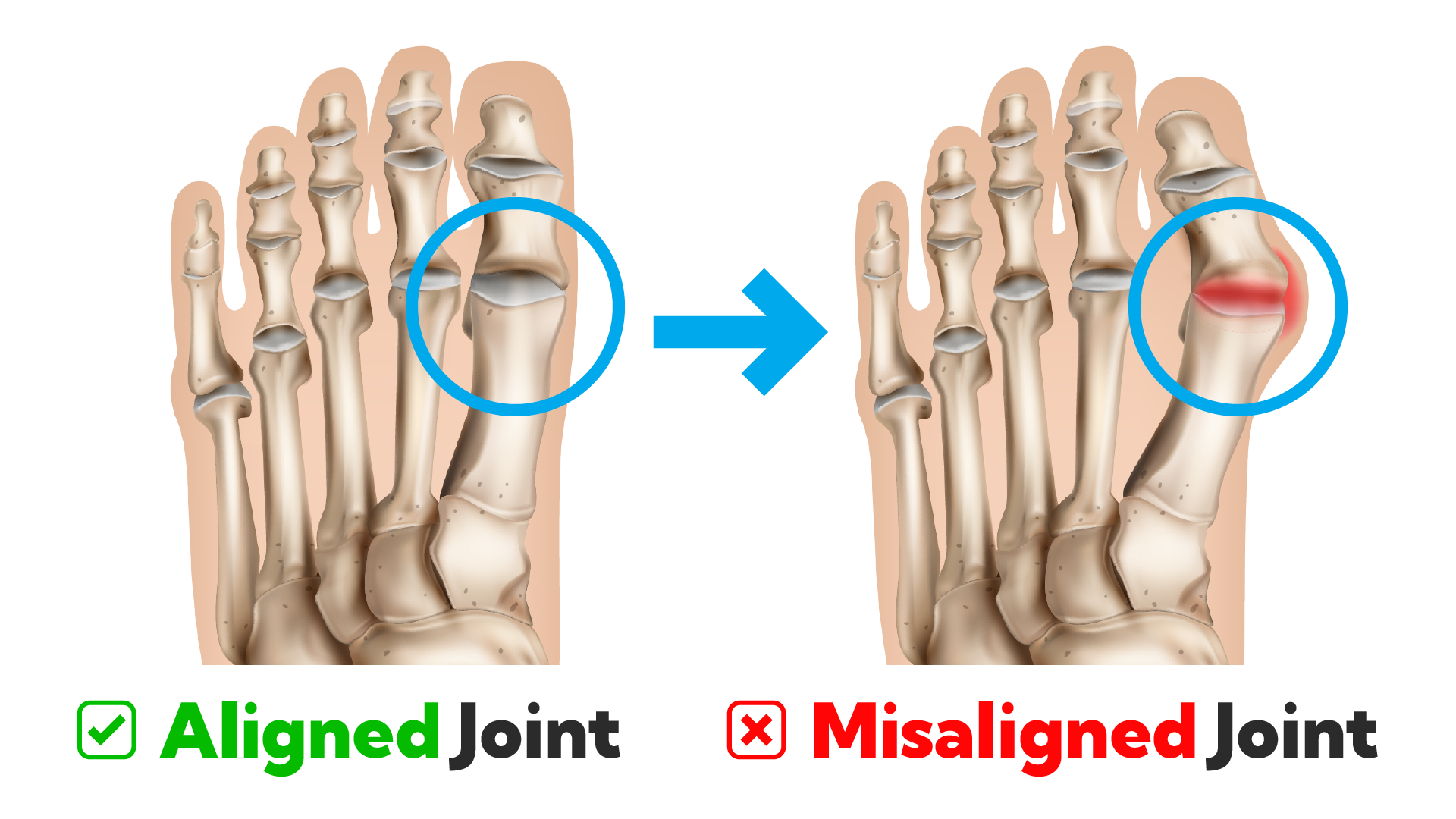 Comparison of an aligned big toe and a misaligned bunion joint