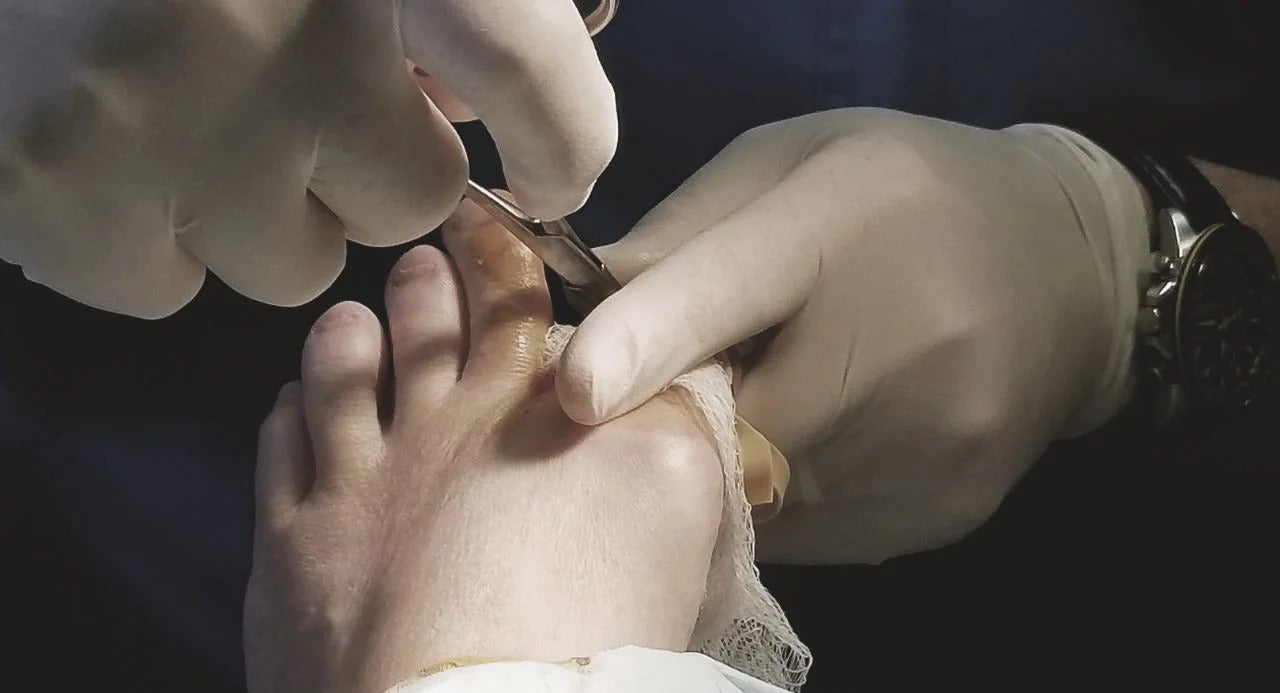 Illustration of bunion surgery