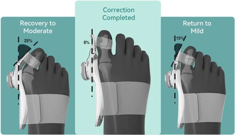 Bunion Fix realigning the big toe joint